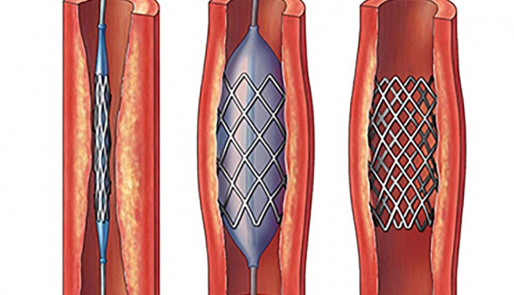 Who and when invented the balloon-expandable stent?