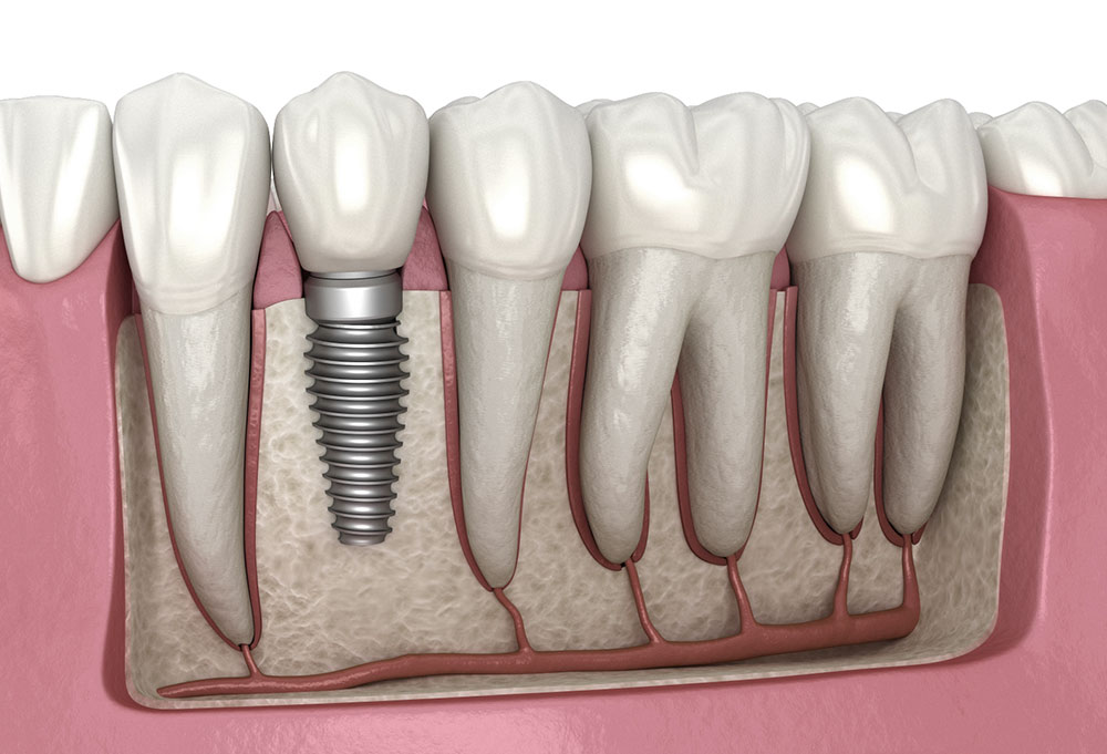 Who invented the implant and how?