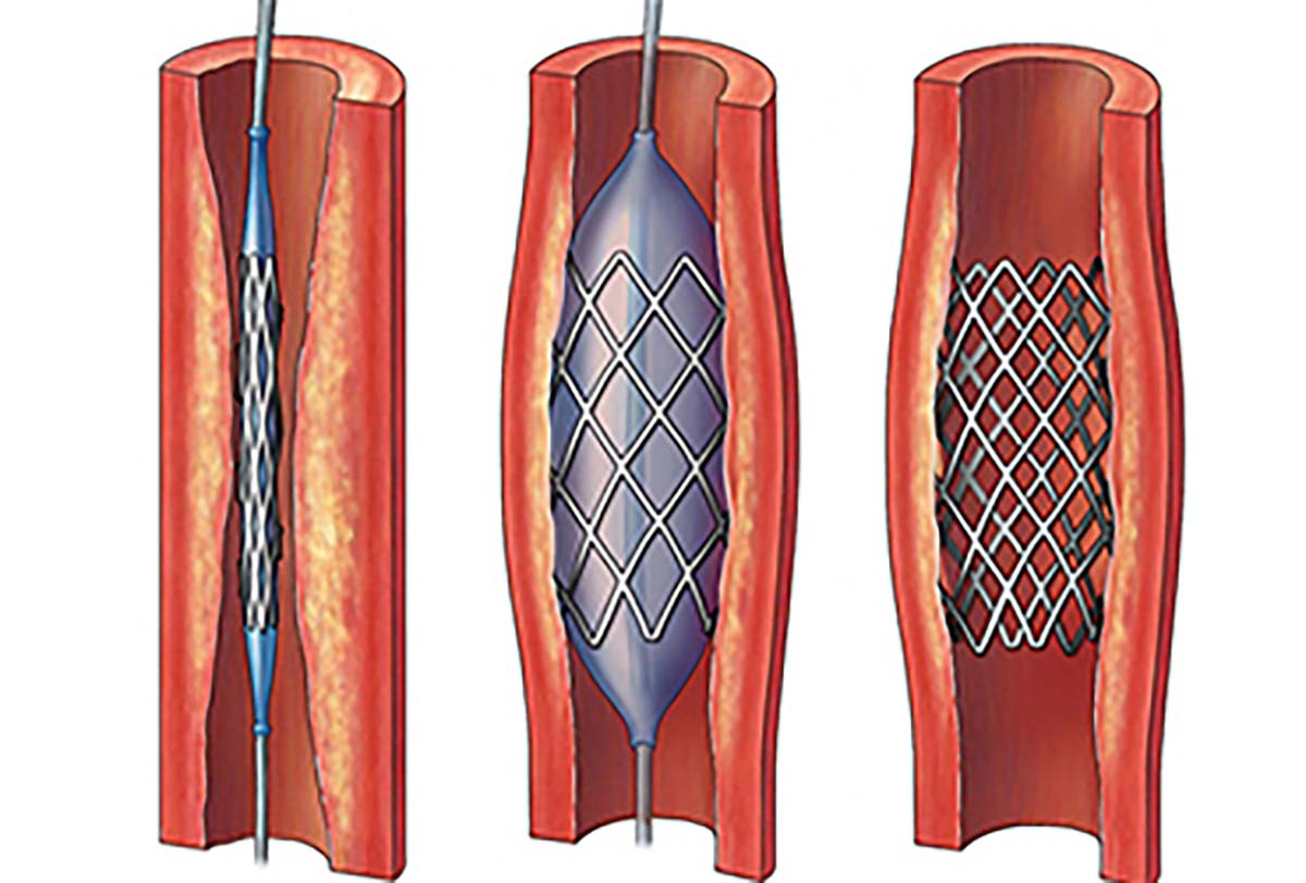 Who and when invented the balloon-expandable stent?